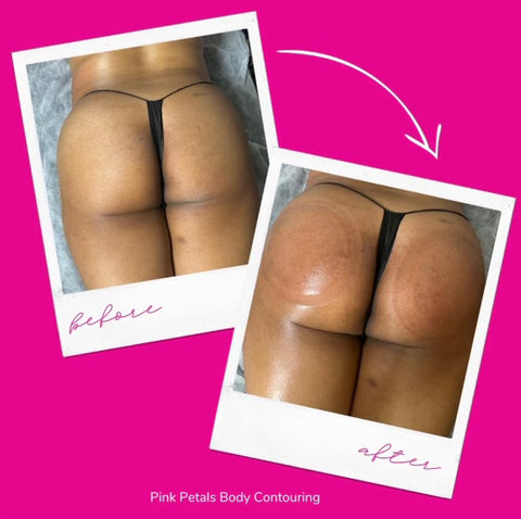 Snatched Waist Sculpting Package (6 treatments)