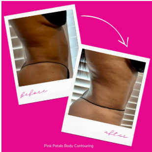 Snatched Waist Sculpting Package (6 treatments)